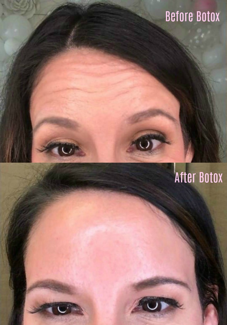 My No BS Post about Botox plus Before and After